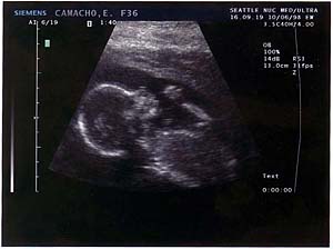 second ultrasound